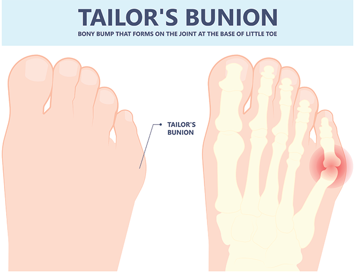 What is a Bunion & How Do You Treat Them? Profoot